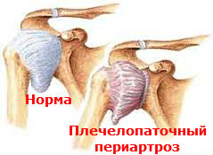 Плечелопаточный периартроз Лечение Киев